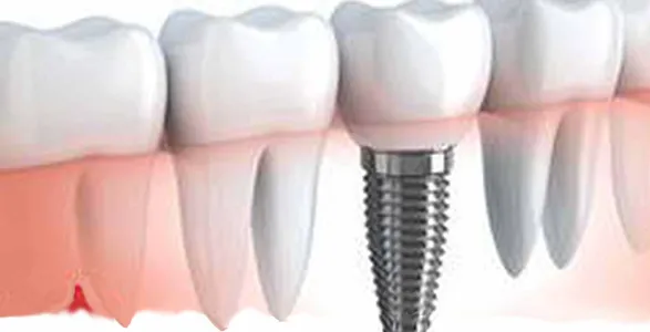 dental implants Scarborough Beach